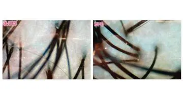 Blog post thumbnail for アデランス体験記